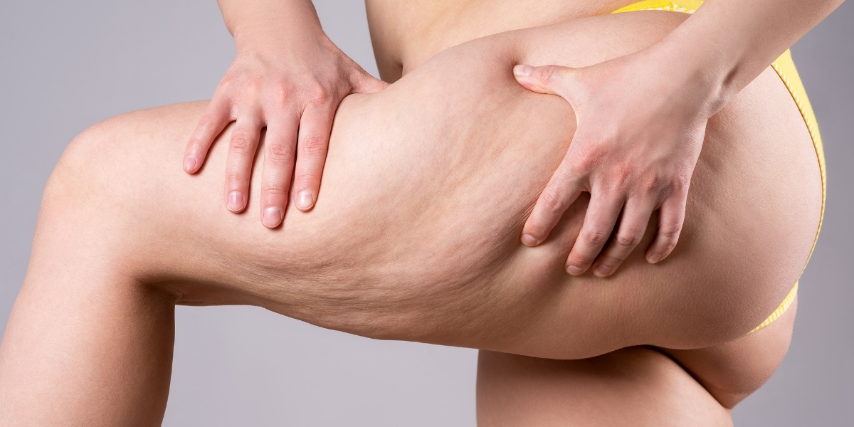 Desvendando os Mitos sobre Celulite: Fatos e Avanços nos Tratamentos