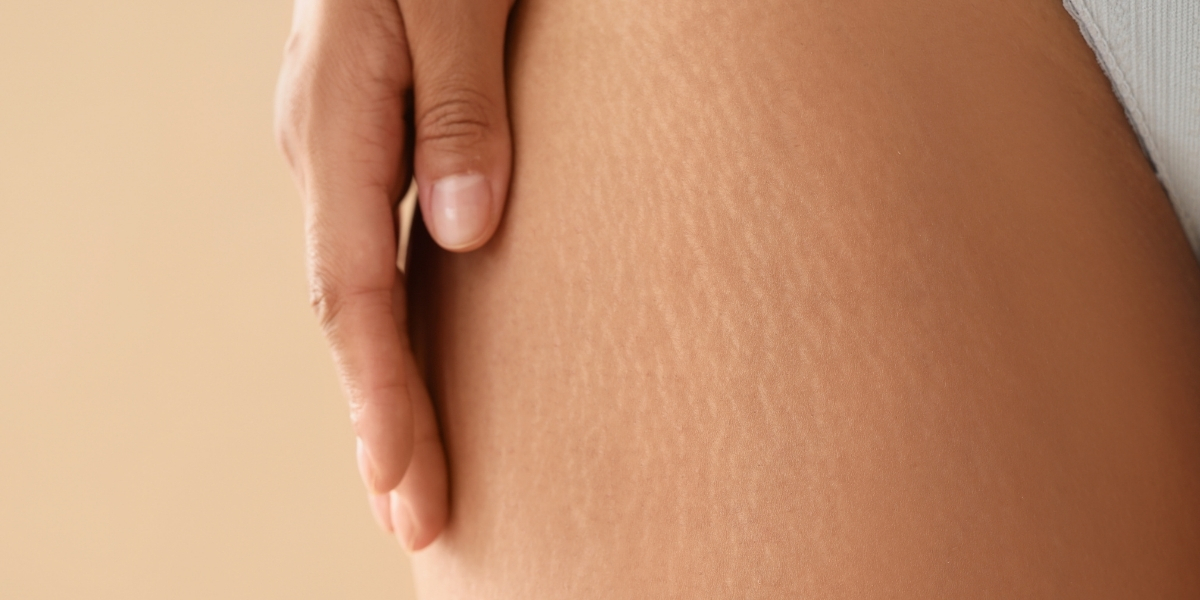 COMO AMENIZAR AS ESTRIAS?