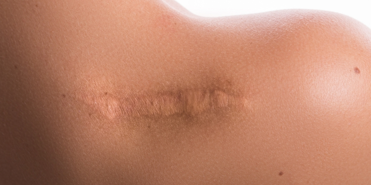 MARCAS E CICATRIZES NUNCA MAIS! TUDO O QUE VOCÊ PRECISA SABER SOBRE AS MARCAS DE ACNE E COMO EVITÁ-LAS!