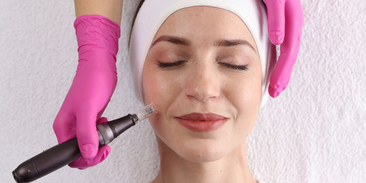 BENEFÍCIOS DO MICROAGULHAMENTO PARA A SUA PELE