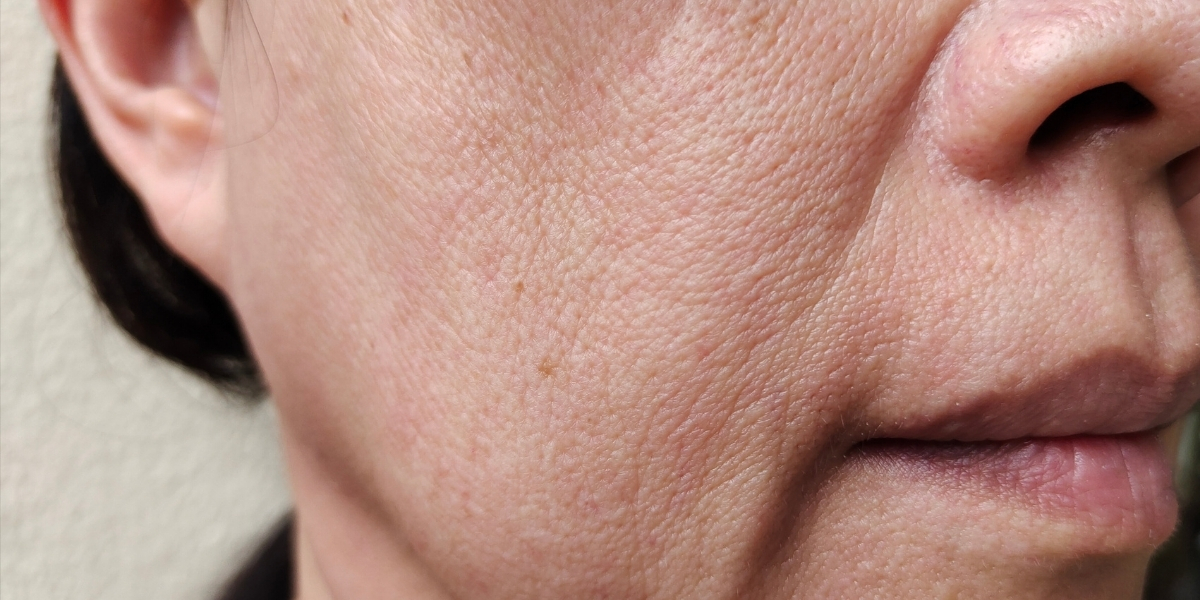 Qual tratamento pode ajudar a minimizar a flacidez? 