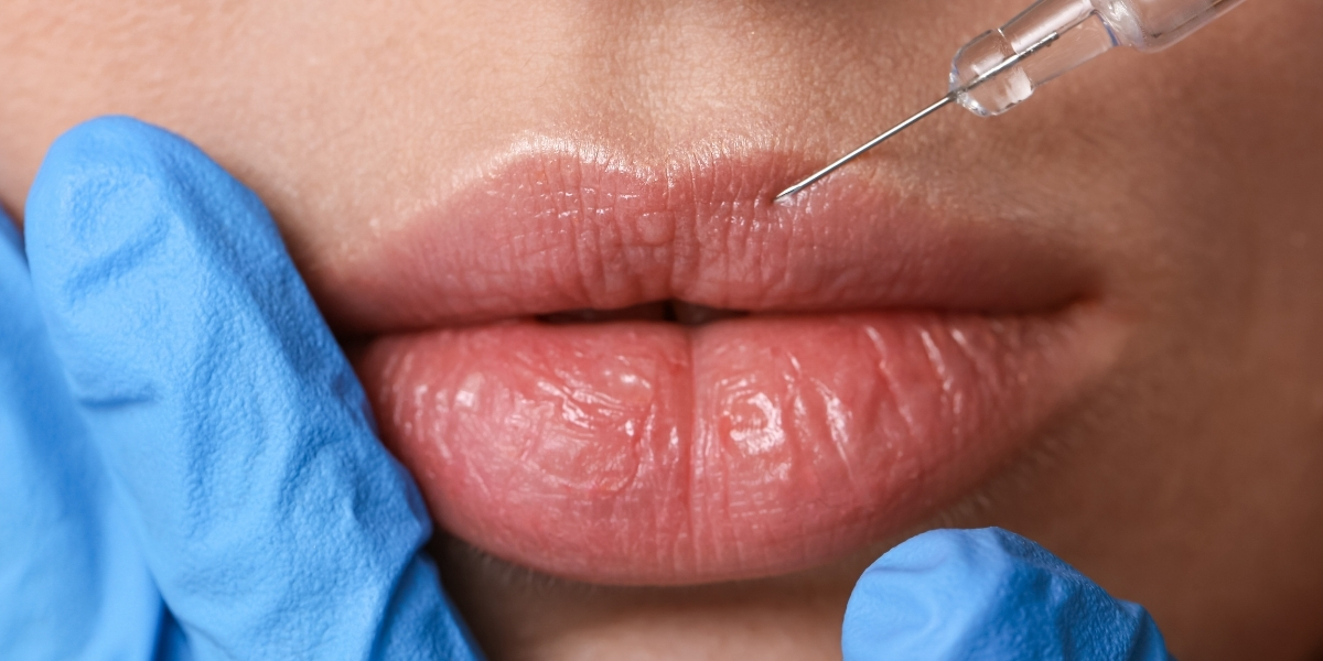 TUDO O QUE VOCÊ PRECISA SABER SOBRE PREENCHIMENTO LABIAL