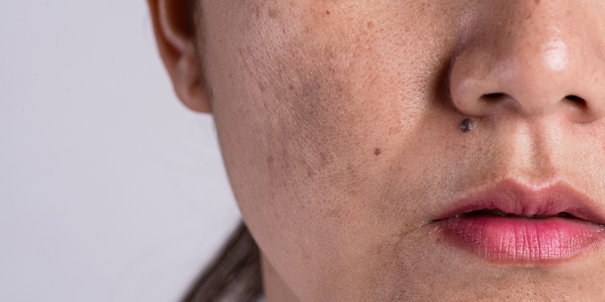 Tratamento para melasma: intradermoterapia