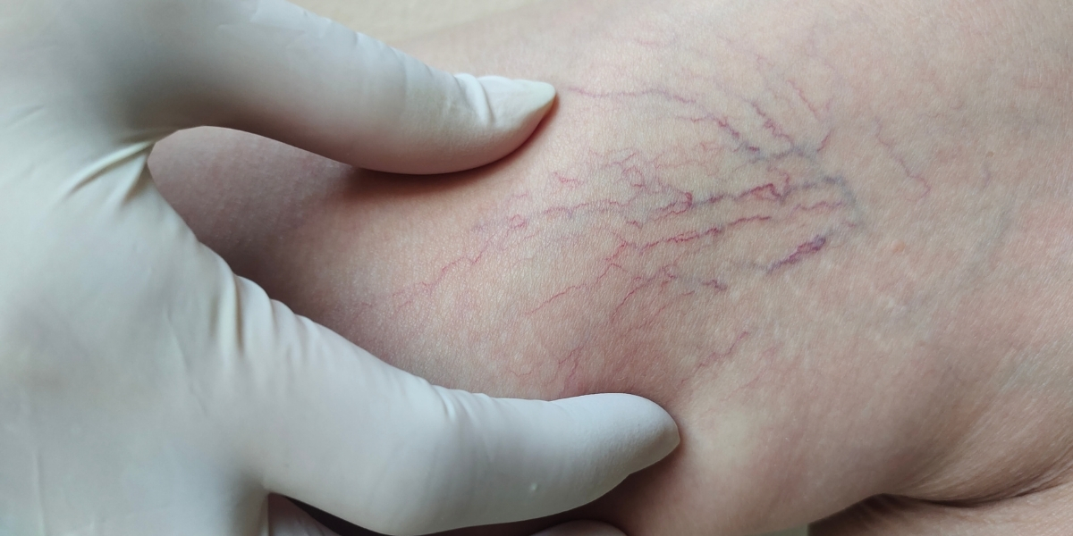 VARIZES E VASINHOS TÊM TRATAMENTO? SAIBA MAIS!