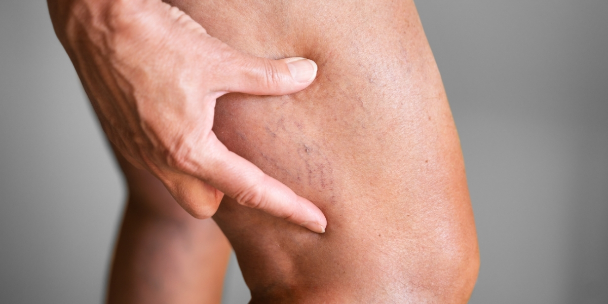 TRATAMENTO DE VARIZES E VASINHOS COM LASER: ESCLAREÇA AS SUAS PRINCIPAIS DÚVIDAS 