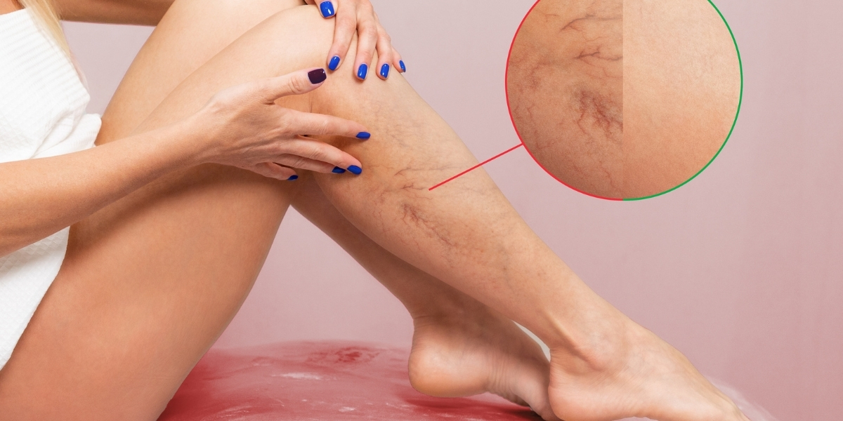 LASER ND YAG 1064 (ACROMA) E LUZ INTENSA PULSADA - ENTENDA A FUNÇÃO DE CADA TRATAMENTO!